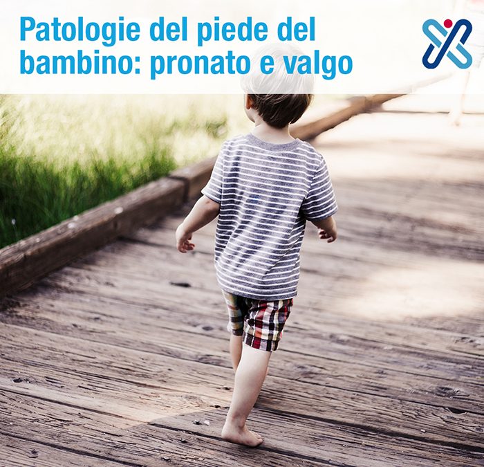 piede pronato bambino