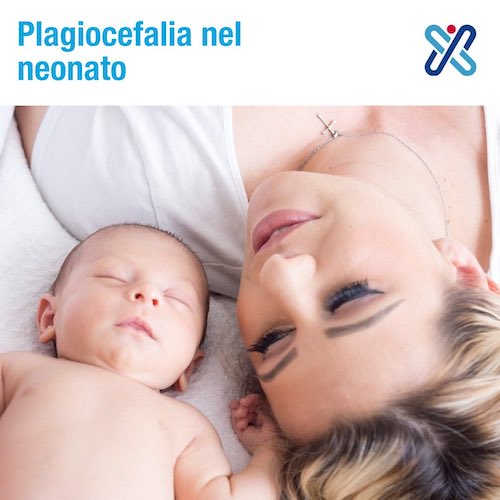 plagiocefalia