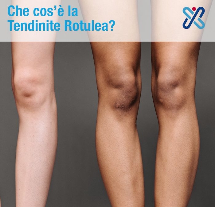 Che cos’è la Tendinite Rotulea?