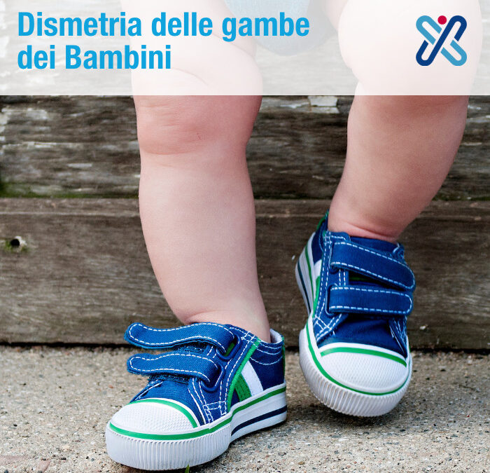 dismetria gambe bambini